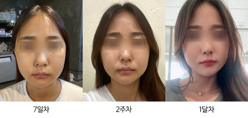 안면윤곽수술과 회복기간의 차이 6