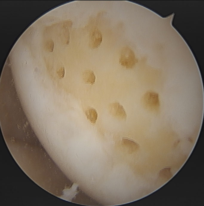 무릎 관절연골 결손(articular cartilage defect)으로 미세천공수술(microfracture) 후 8개월차 ...