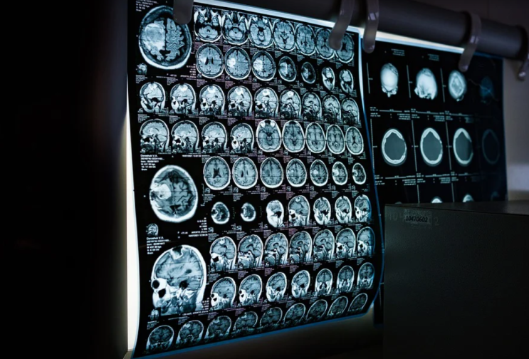 MRI (DWI,ADC - 급성 뇌경색 진단)