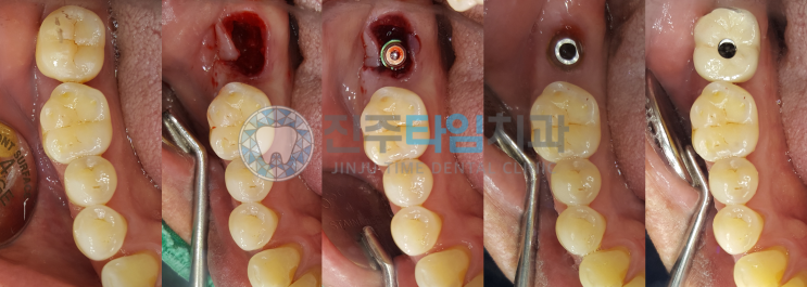  치주염, 발치즉시 임플란트 #파노라마/CT difference #진주치과