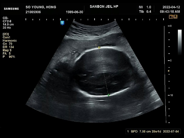 임신 29주 2일, 태아의 딸꾹질 시작 & 역아일 경우 임산부 운동법