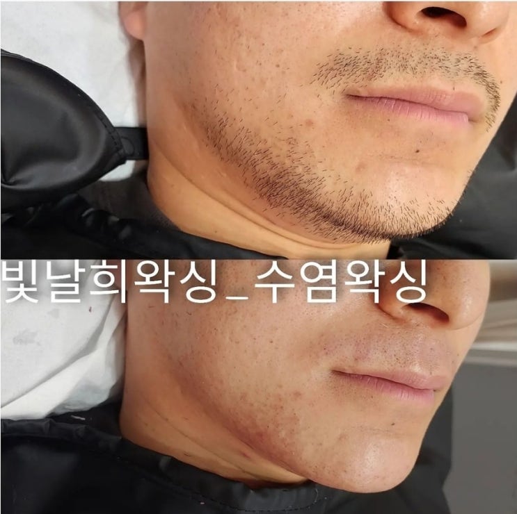  면도할때 트러블때문에 고민이라면 수염왁싱으로 관리해보세요:)