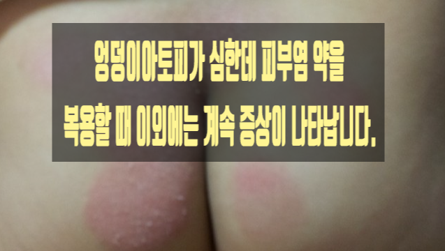  엉덩이아토피가 심한데 피부염 약을 복용할 때 이외에는 계속 증상이 나타납니다.