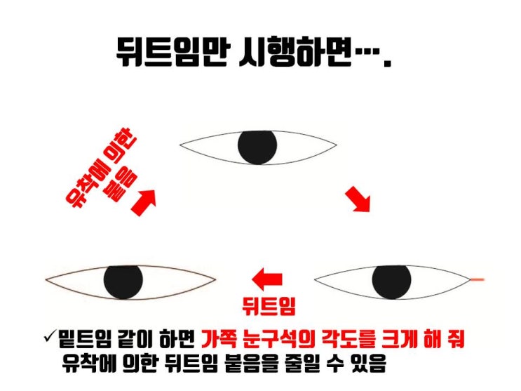  뒤트임과 밑트임을 같이 시행하면 정말 좋은 점이 많죠!!!