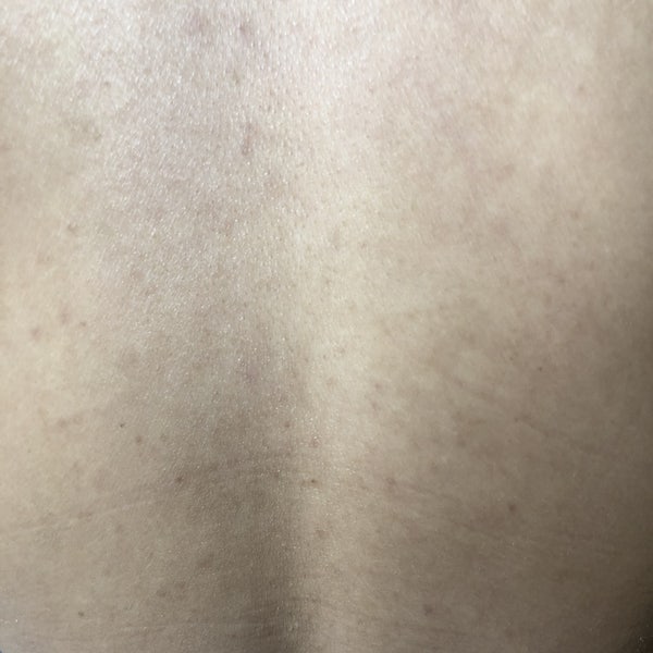 등여드름 피부과 가서 등드름 흉터 박살낸 후기