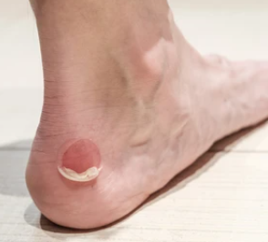 물집 생겼을때 올바르게 대처하는 팁
