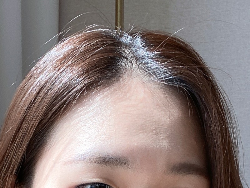 강남역 피부과 제오민보톡스 부작용 없는 이마, 미간주름 보톡스 재방문 전후 차이 효과
