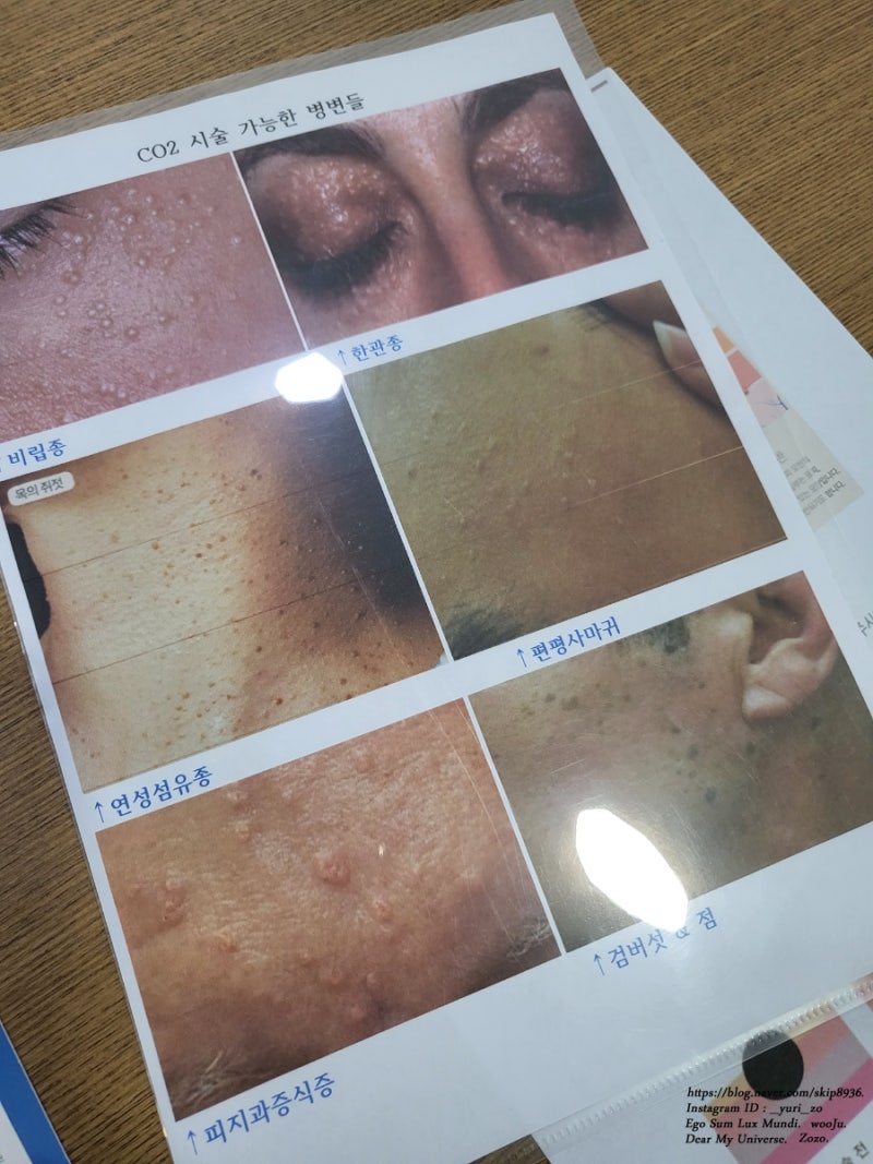 편평 사마귀 피지선 과형성 제거 레이저 회춘 크림 비용 검토 사마귀 제거 후 피부과 회춘 크림 구매 편평 사마귀 피지선 과형성 제거 레이저 회춘 크림 비용 검토 사마귀 제거 후 피부과 회춘 크림 구매