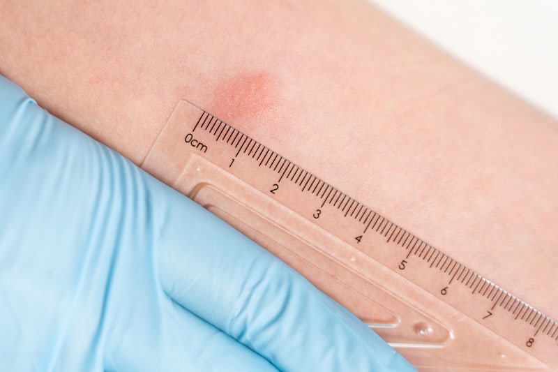tuberculosis-ppd-test-quantiferon-test-igra