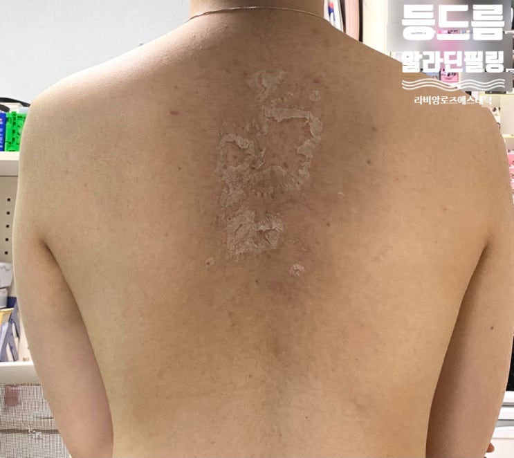  회기피부관리 여름은 다가오는데 등여드름때문에 고민이라면?