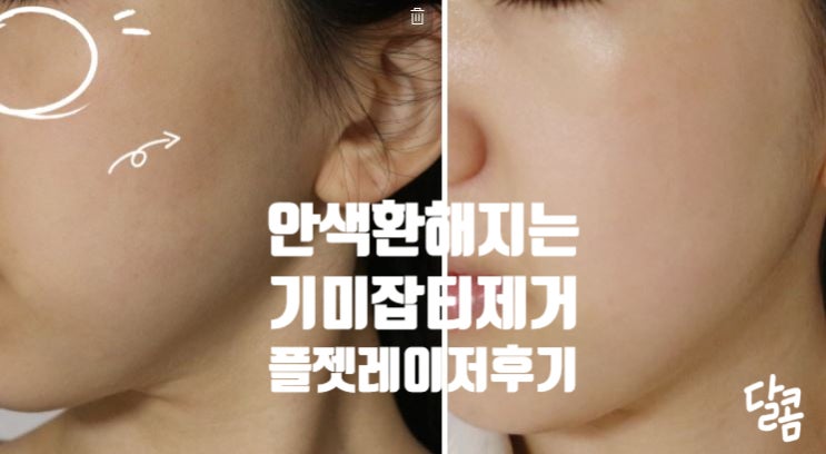  기미잡티 레이저 눈꽃플라즈마, 리프팅 주름개선 토르레이저 솔직한 후기