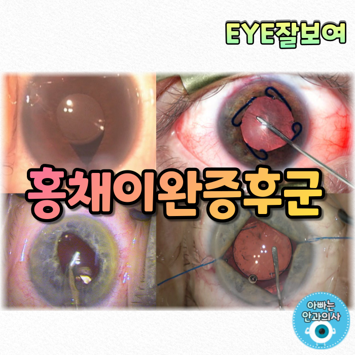  [EYE잘보여] 백내장 수술, 이럴 땐 어떻게? - 홍채이완증후군(IFIS)