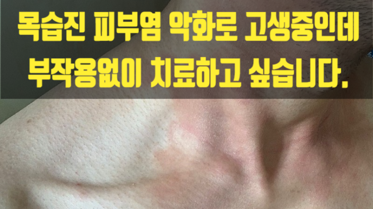  목습진 피부염 악화로 고생 중인데 부작용없이 치료하고 싶습니다