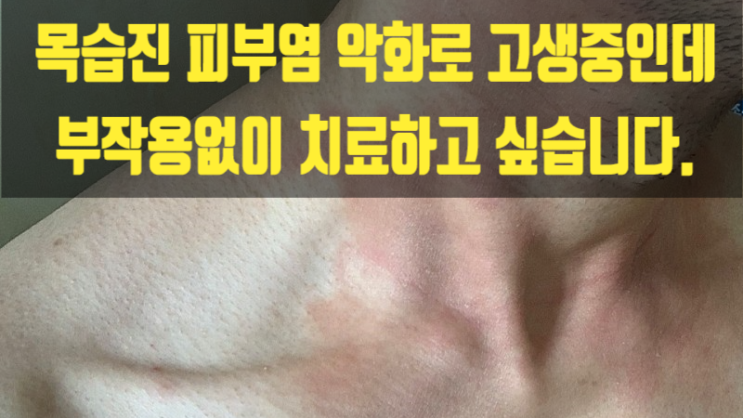 목습진 피부염 악화로 고생 중인데 부작용없이 치료하고 싶습니다