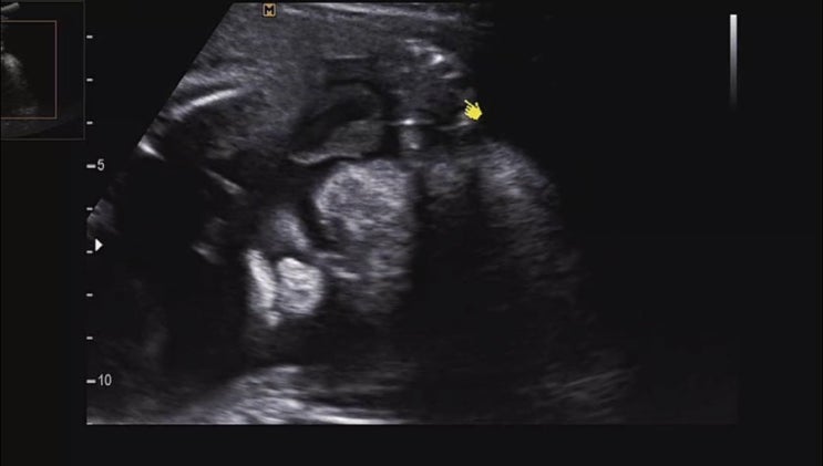 [임신 28주6일차] 배크기/변화/증상