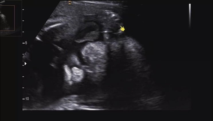  [임신 28주6일차] 배크기/변화/증상