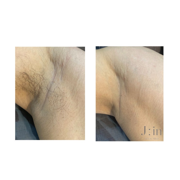  상동왁싱 / 상동역왁싱/부천왁싱/ 중동왁싱/ 겨드랑이왁싱/ 제이인왁싱