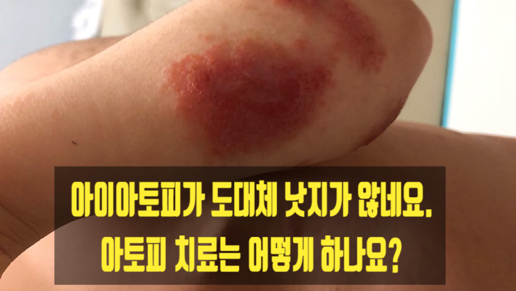  아이아토피가 도대체 낫지가 않네요. 아토피 치료는 어떻게 하나요?