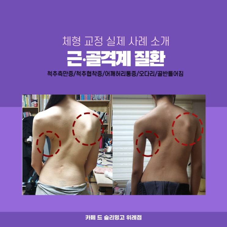  체형교정사례 : 척추측만증 청소년 교정 사례(슬리밍고 위례점)
