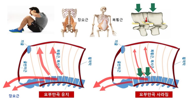  윗몸일으키기(싯업, sit up)와 허리 통증(back pain), 장요근, 복직근, 복사근, 흉요근막