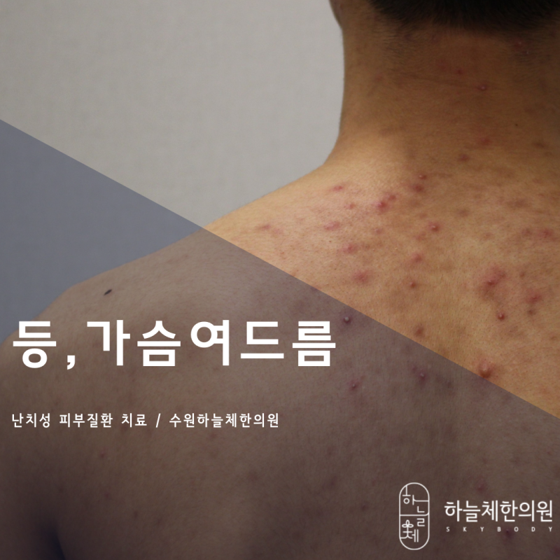수원가슴여드름 색소침착 없애려면 4