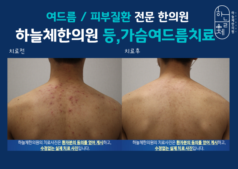 수원가슴여드름 색소침착 없애려면 8