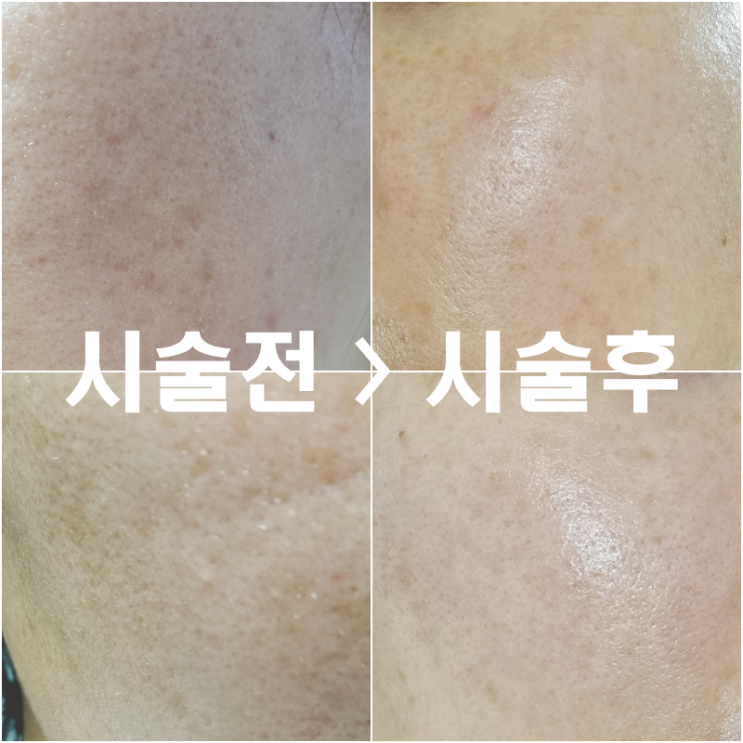  " 깐달걀 피부비결 " 적나라한 해초박피 실제후기