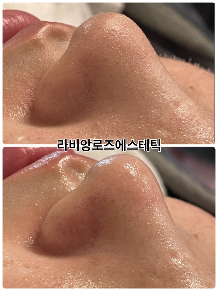  청량리피부관리 코피지랑 블랙헤드 제거는 피지연화제와 아쿠아필링이면 끝납니다.
