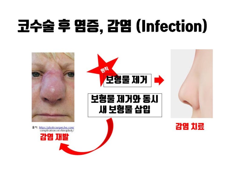 코수술 후 염증과 감염이 의심될 때 진피지방이식으로 보형물 제거와 코재수술 동시에 가능헤요!!!