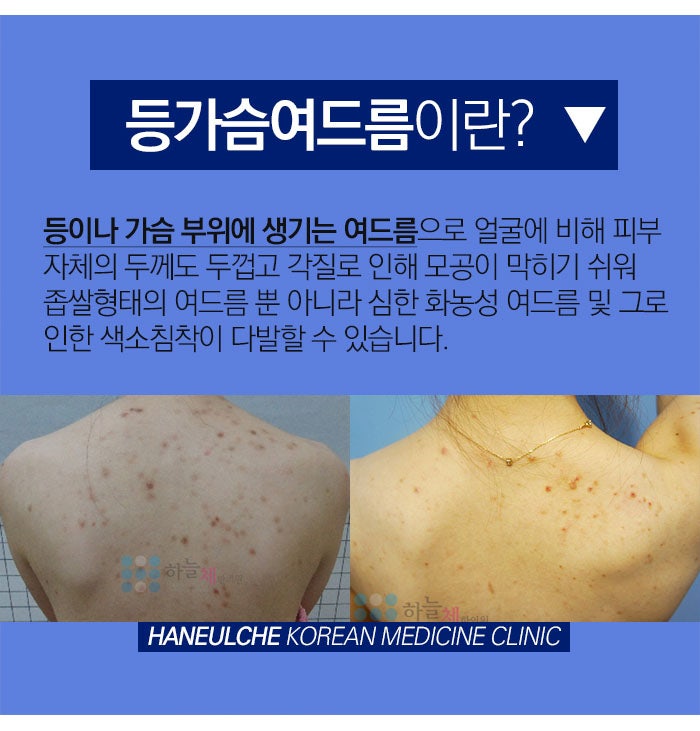 수원가슴여드름 색소침착 없애려면 7