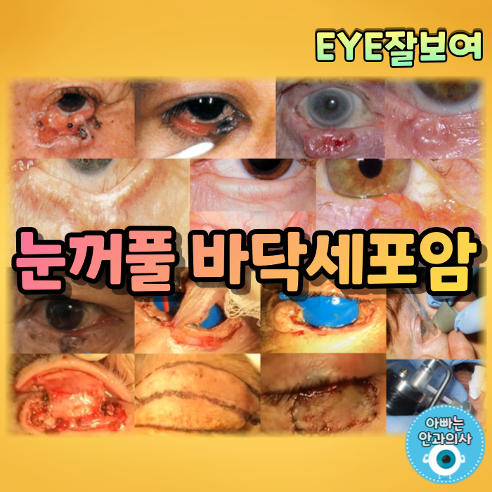 [EYE잘보여] 눈꺼풀의 악성 종양 - 바닥세포암(BCC)