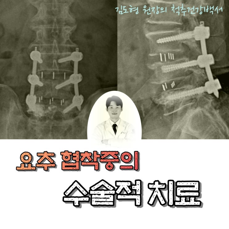  요추 협착증의 수술적 치료 (감압술 vs 유합술 나사못 고정술)