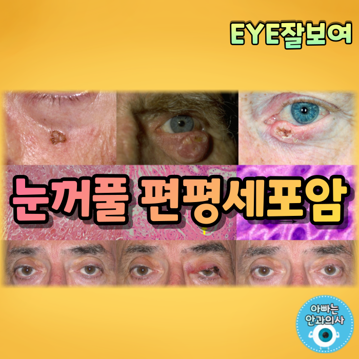 [EYE잘보여] 눈꺼풀의 악성 종양 - 편평세포암(SCC)