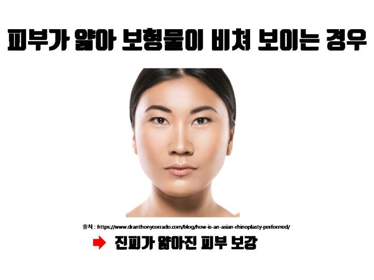  코재수술 시 실리콘 보형물보다 자가진피지방 이식이 절대적으로 유리한 경우 !!!