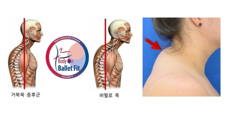 [길벗 칼럼] 목과 어깨가 아프다면, ‘거북목증후군’을 의심하자