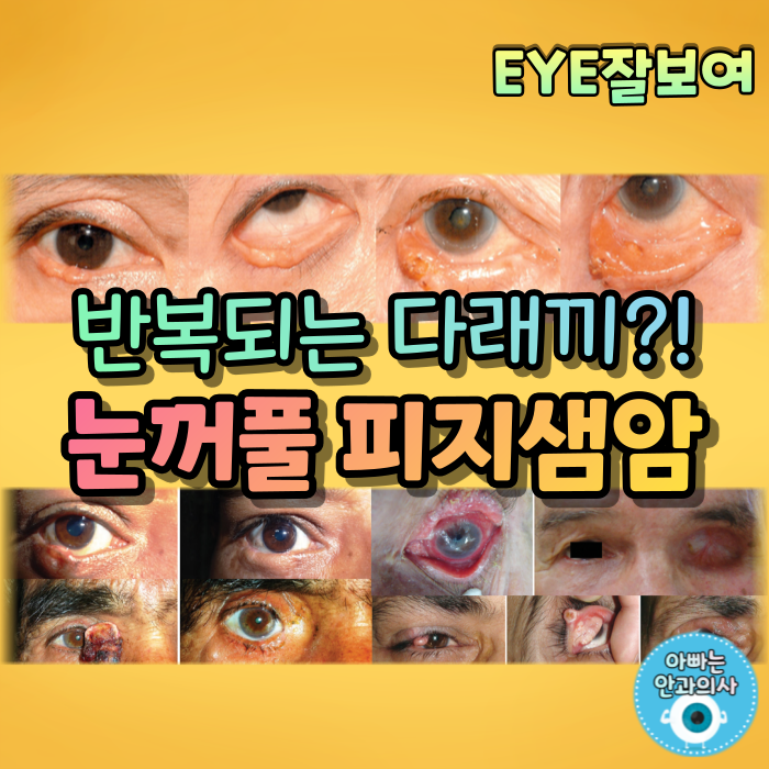[EYE잘보여] 눈꺼풀의 악성 종양 - 피지샘암(다래끼가 잘 안낫는다면?)