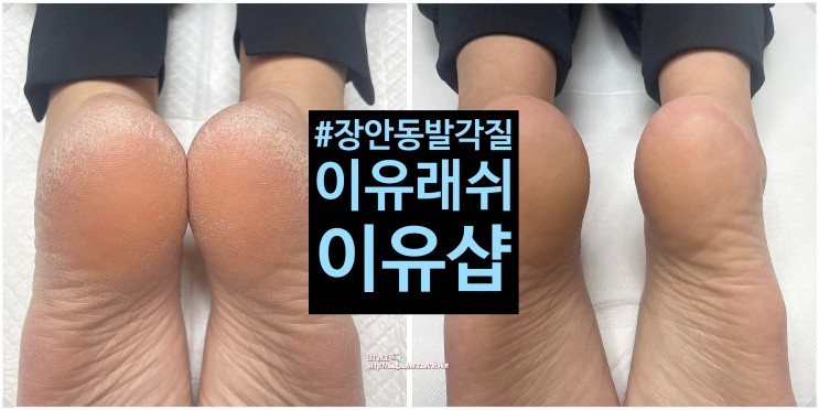 장안동발각질 이유래쉬이유샵 발뒤꿈치 깨끗