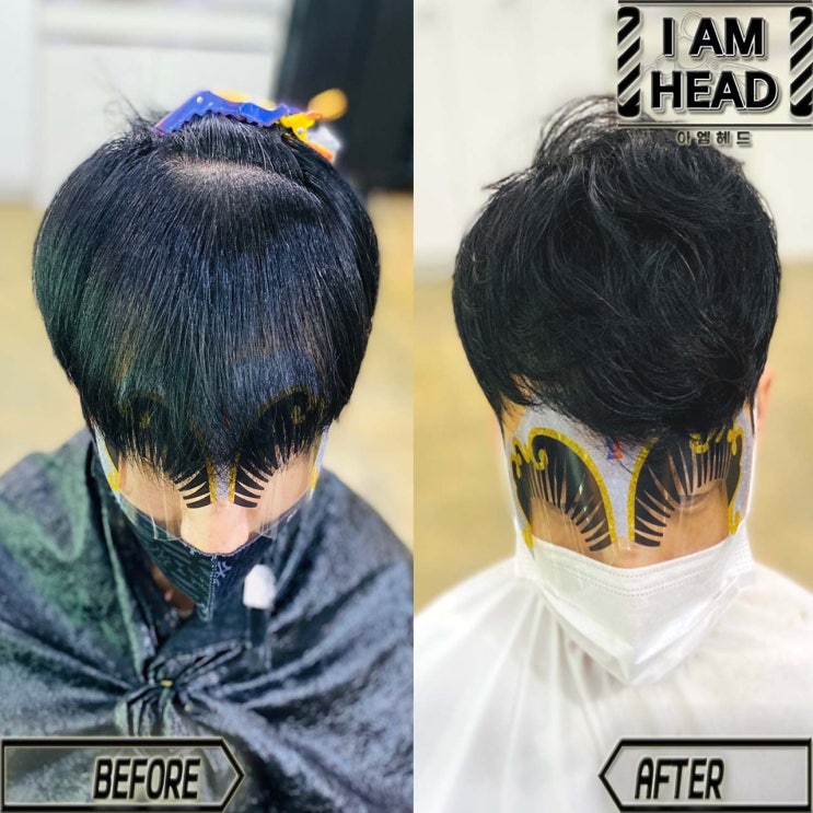 M자탈모커버펌 단점커버엔 역시 링거펌!