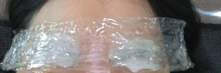  눈썹 문신 제거 2회 후기