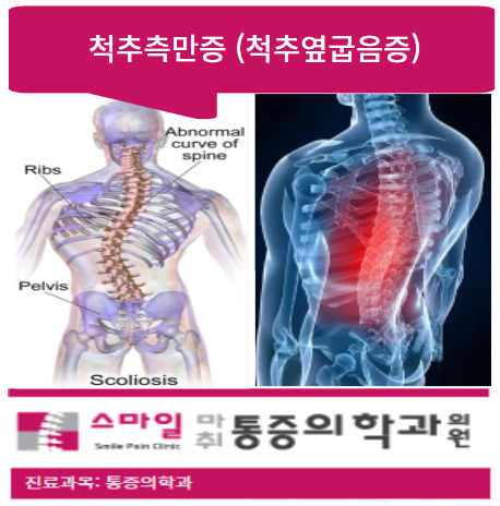  [허리가 휘는 척추옆굽음증] 척추측만증 원인.증상부터 치료까지