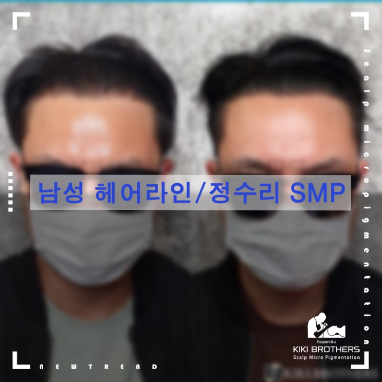  헤어라인부터 정수리탈모까지!! 태릉 탈모커버/수강 전문 두피문신 키키브라더스