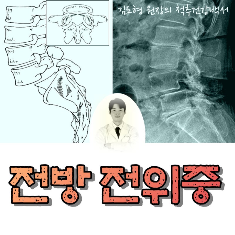 척추전방전위증, 꼭 3