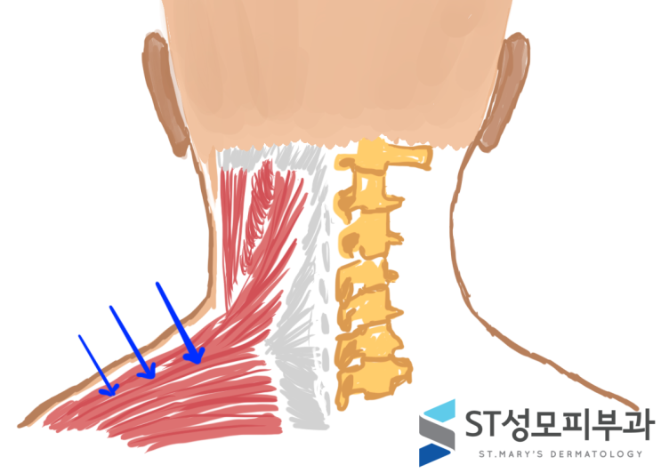  피부과전문의가 설명하는 승모근 보톡스 및 가능한 부작용 - 삼성동 닥터림