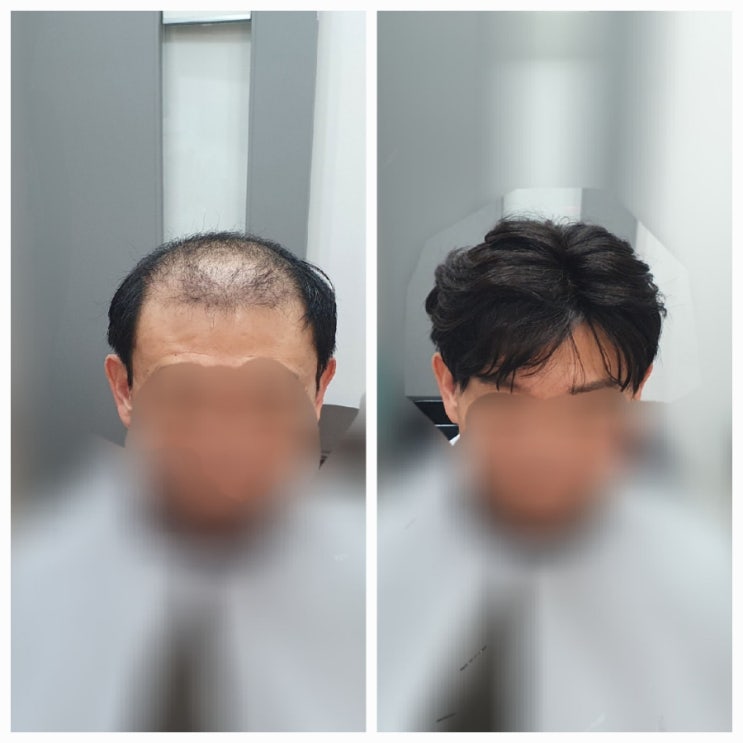  사우나 가려면 보톡스증모술 해야죠! [춘천가발/춘천증모전문점]