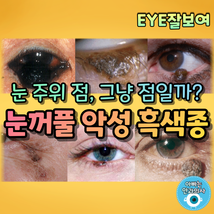 [EYE잘보여] 눈꺼풀의 악성 종양 - 악성 흑색종