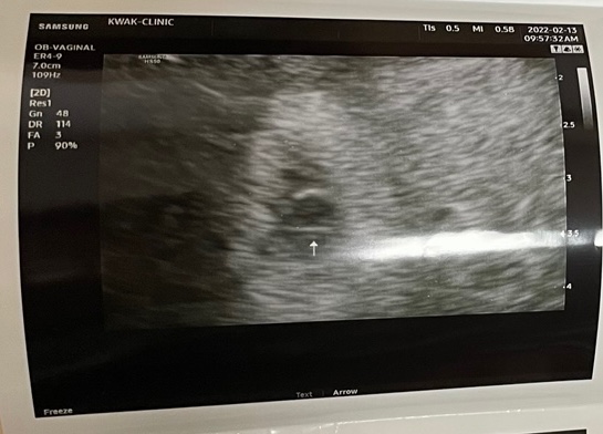  [임신초기~16주] 혼전임신으로 딴딴이가 생기다!!