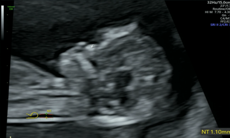 [임신 11주] 1차 기형아 검사 NT 태아 목덜미 투명대검사