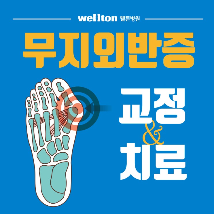  [무지외반증병원] 발바닥통증치료, 편한 발걸음을 위한 바른 치료