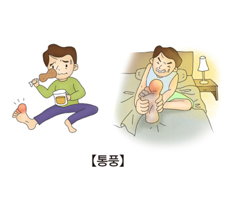  [통풍]통풍의 증상과 진단 및 치료, 예방식품