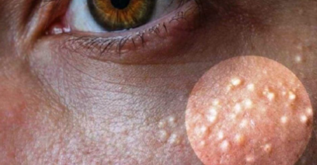 Eye Milia Dermatology 가격 / 스스로 얼굴 Milia를 제거하는 방법